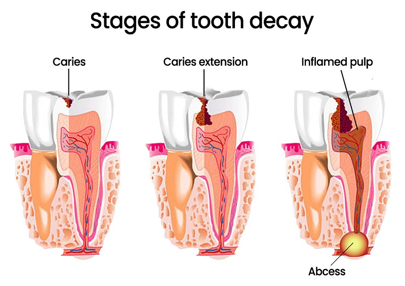 عوامل مسبب ایجاد آبسه دندان