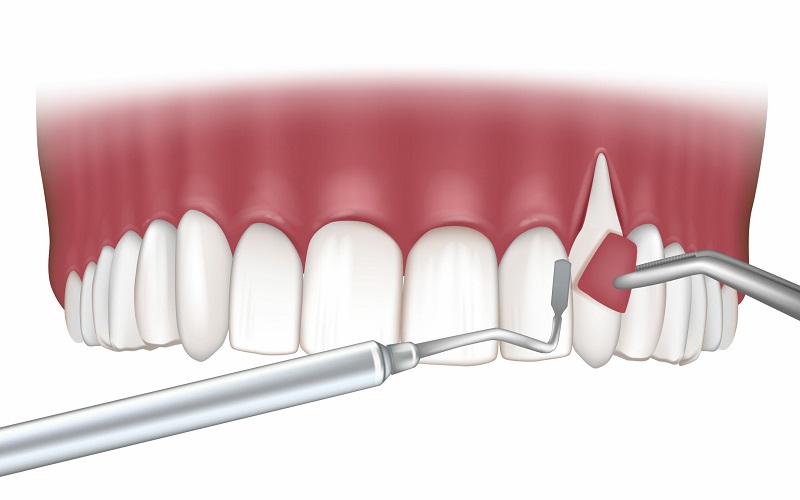 جراحی افزایش طول تاج دندان ( Crown Lengthening) 