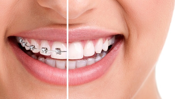 عوارض ارتودنسی دندان چیست؟ 