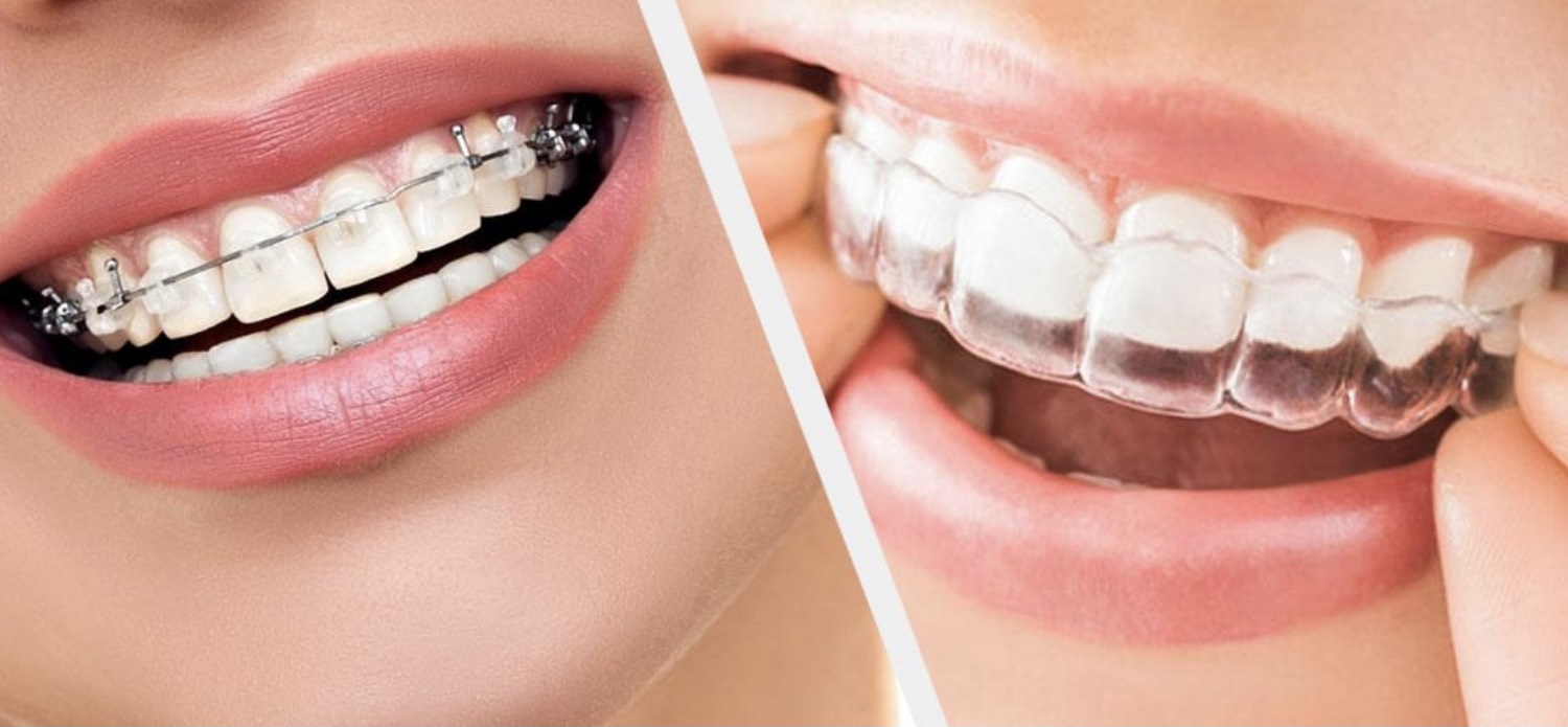 انواع ارتودنسی دندان 