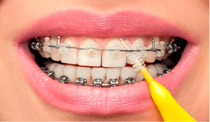 مراقبت‌های مناسب برای ارتودنسی دندان 