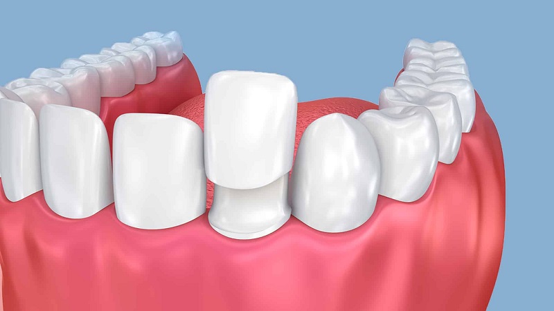 دلایل افتادن لمینت دندان چیست و چگونه میتوان از آن جلوگیری کرد؟