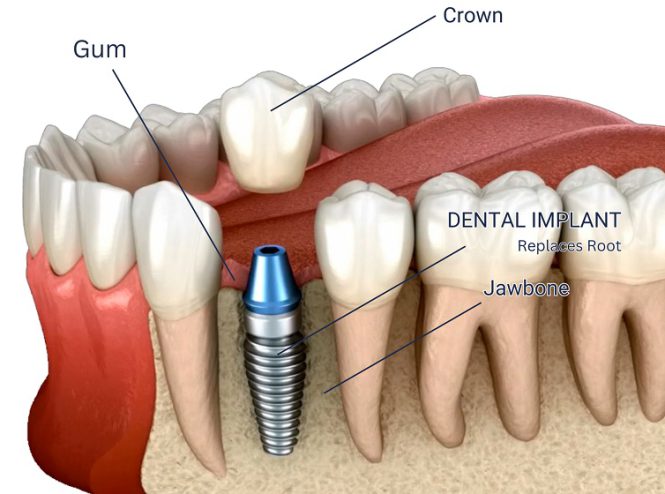 ایمپلنت دندان چیست؟ مزایا، معایب و نحوه انجام چگونه است؟