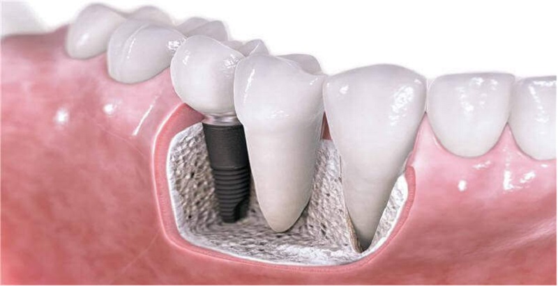 مزایای ایمپلنت دندانی 
