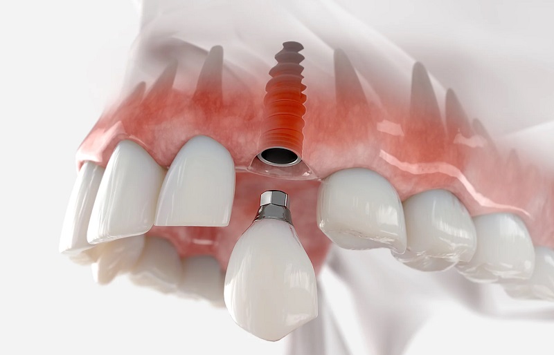 عوارض ایمپلنت دندان 