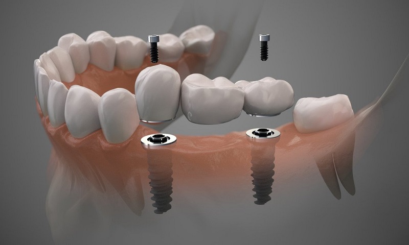 عوارض و معایب ایمپلنت دیجیتال دندان