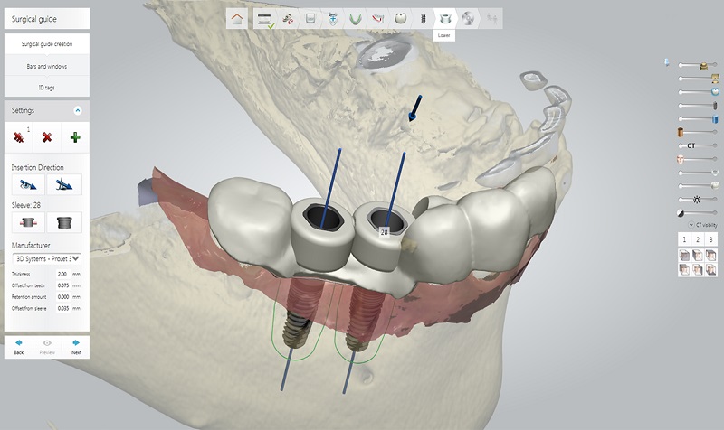 ایمپلنت دیجیتال دندان چیست؟