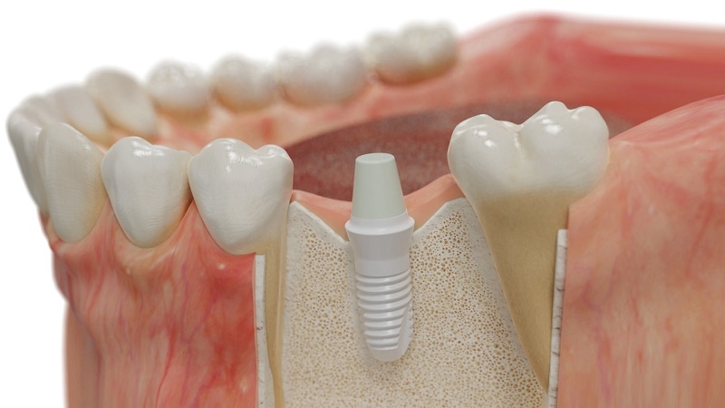 افراد زیر می‌توانند با خیالت راحت انواع ایمپلنت دندانی را انجام دهند 