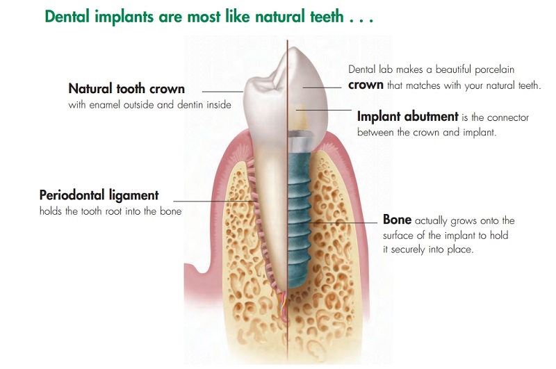 انواع روش انجام ایمپلنت دندان 