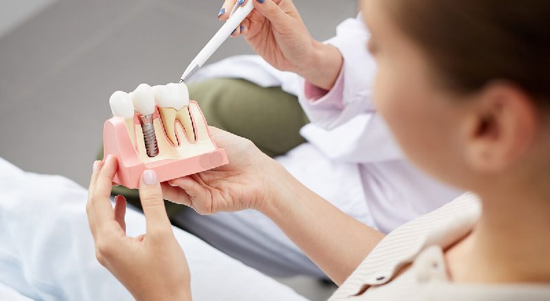 ایمپلنت فوری دندان چیست | مزایای ایمپلنت یک روزه