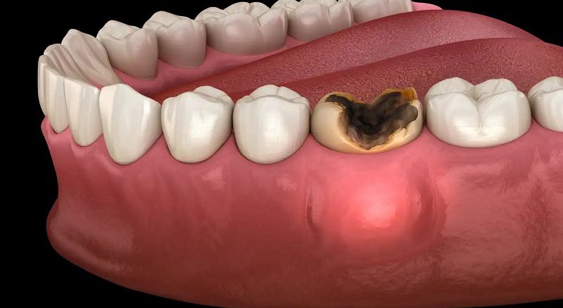 37 درمان خانگی عفونت دندان