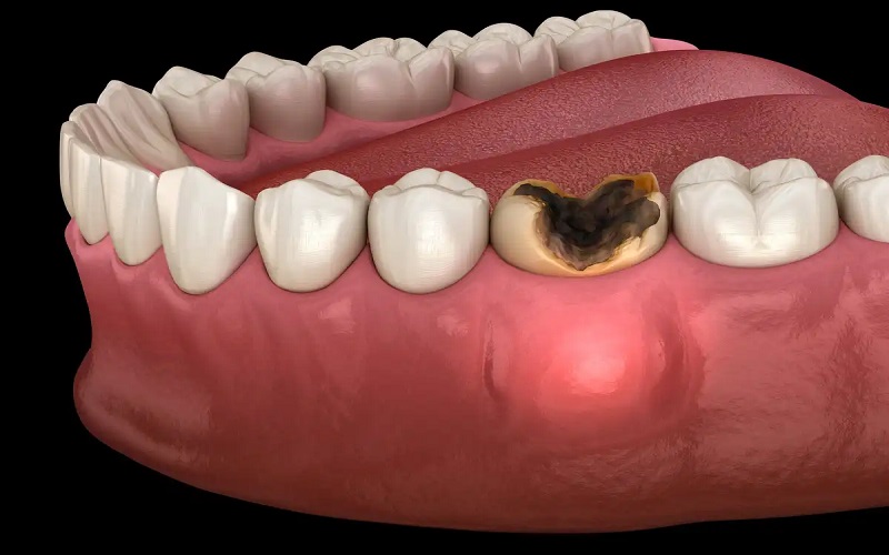 37 درمان خانگی عفونت دندان