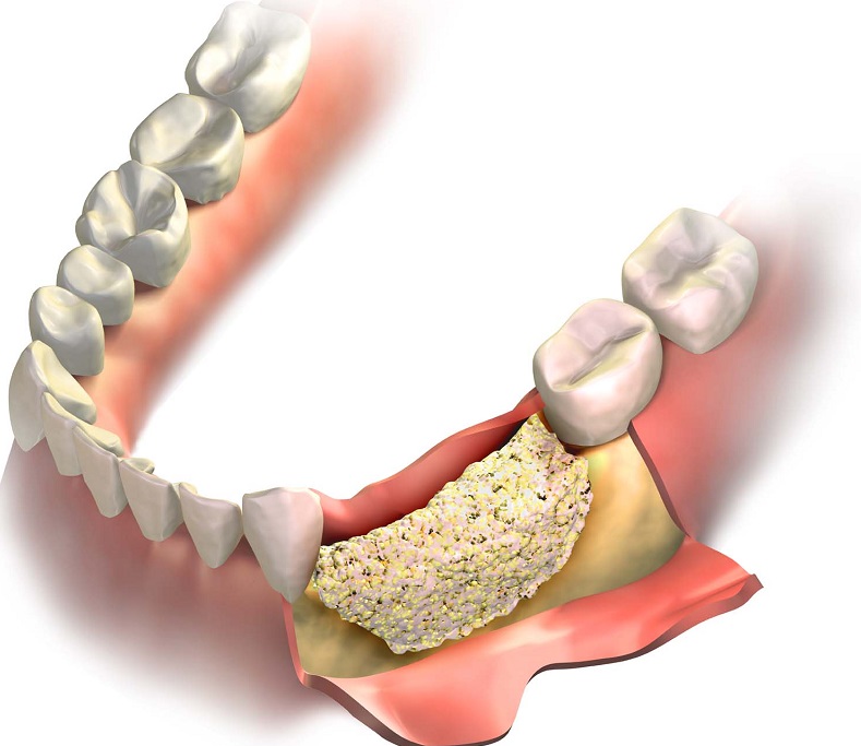 پیوند استخوان فک (برای کاشت ایمپلنت دندان) چیست؟