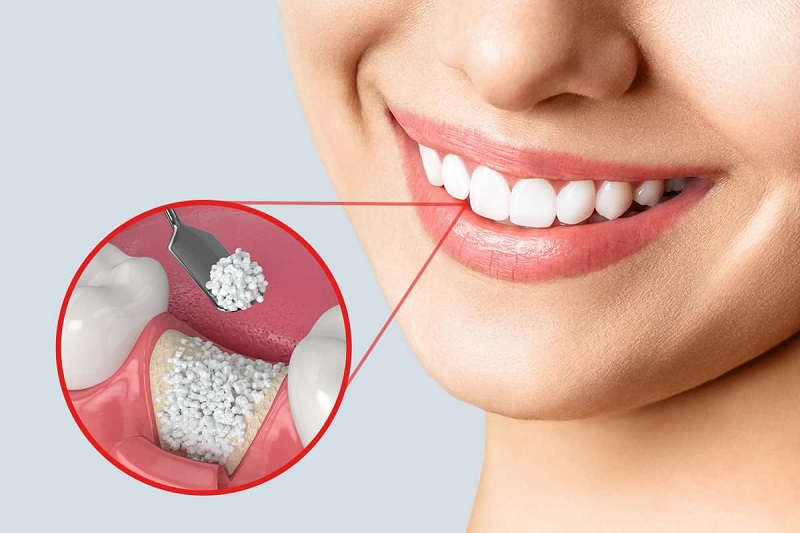 مزایای پیوند استخوان دندان برای ایمپلنت 