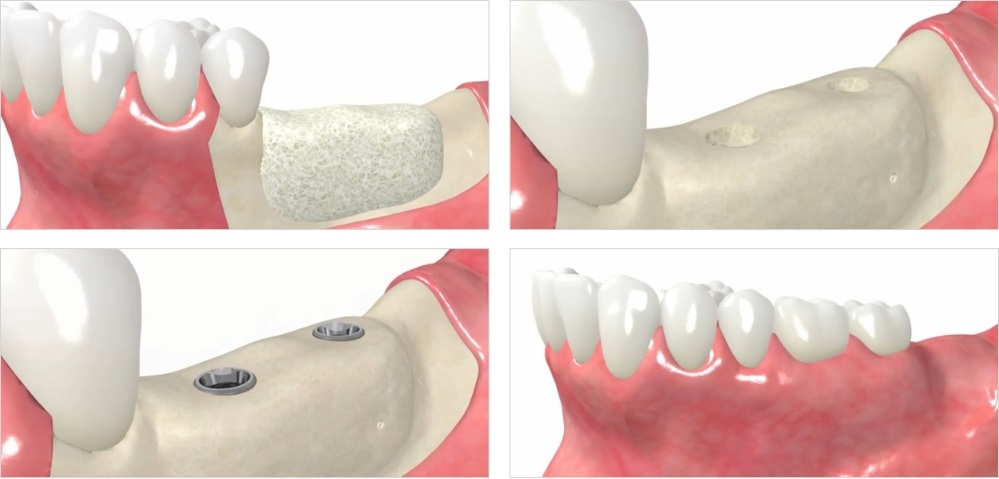 انواع روش پیوند استخوان پیش از کاشت ایمپلنت دندان 