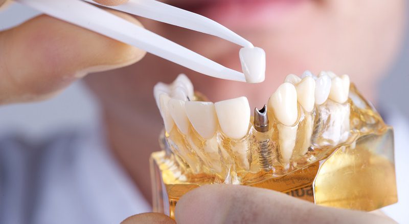 انواع روش کاشت دندان چیست و بهترین متد کدام است