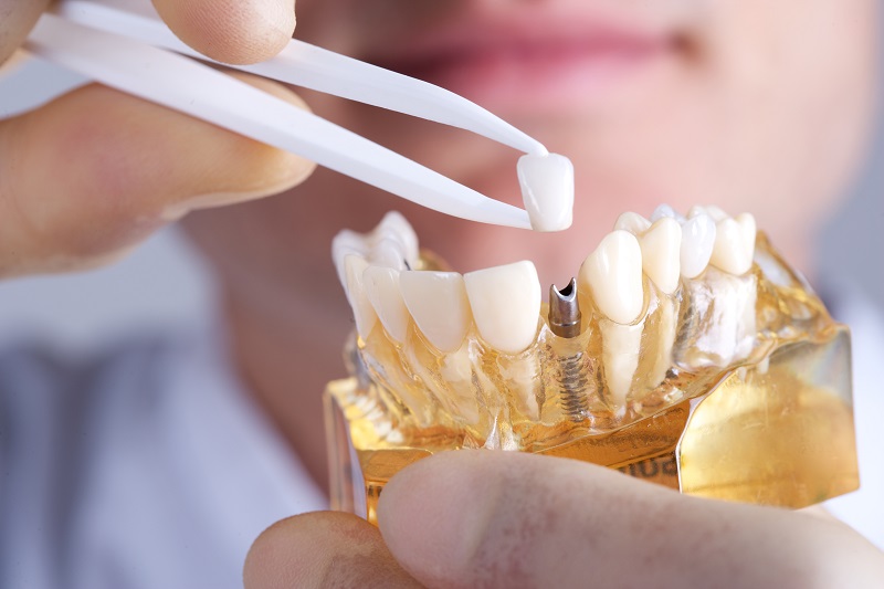 انواع روش کاشت دندان چیست و بهترین متد کدام است
