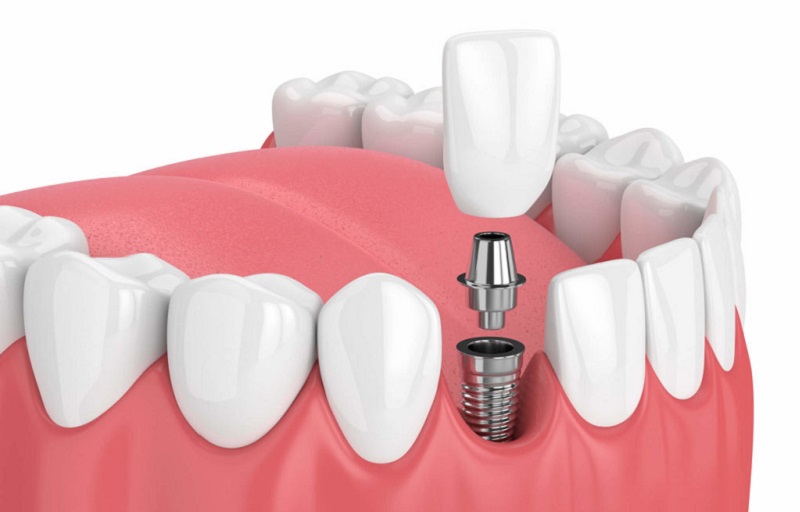 کاشت ایمپلنت دندان چیست؟ 