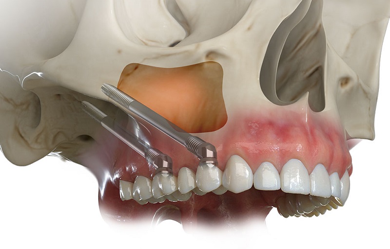 کاشت دندان به روش زایگما ( Zygomatic Implant ) 