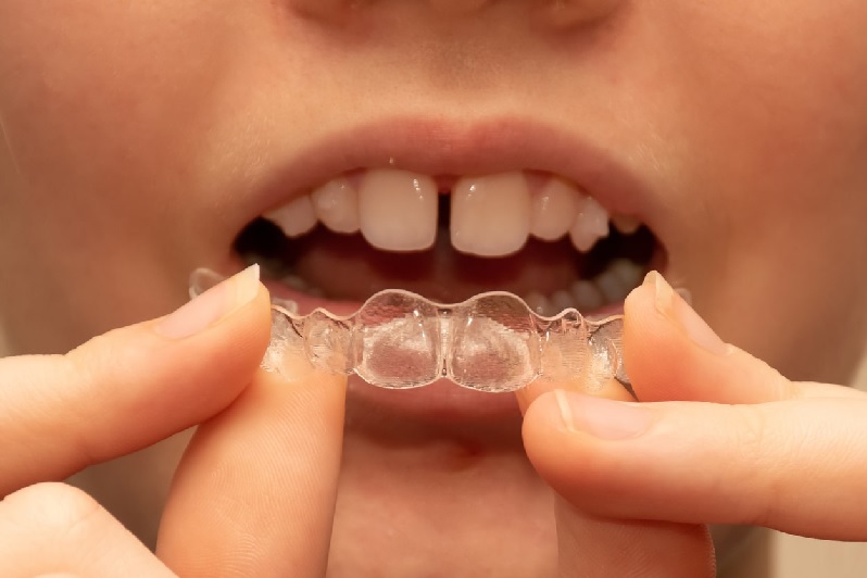 مزایای ارتودنسی دندان فاصله‌دار چیست؟ 