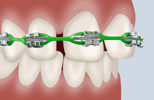 ارتودنسی دندان فاصله‌دار چیست؟ درمان فاصله بین دندان ها
