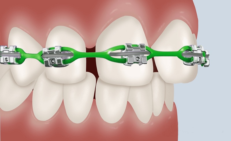 ارتودنسی دندان فاصله‌دار چیست؟ درمان فاصله بین دندان ها