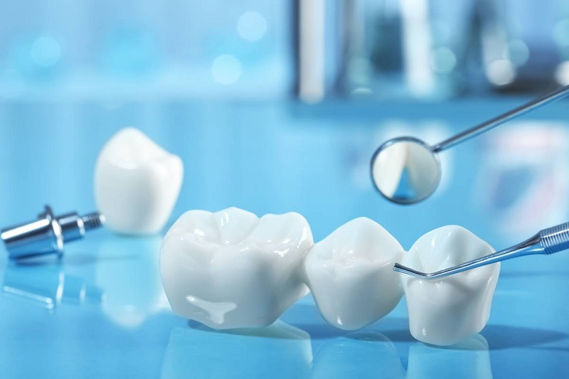 بریج دندان چیست؟ درباره انواع بریج دندان + چگونه انجام می‌شود و چقدر دوام دارد؟