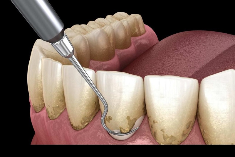 انواع جرم‌گیری دندان 