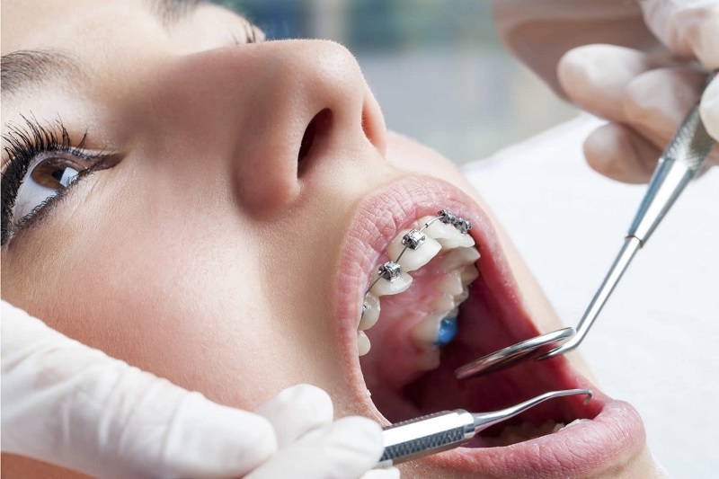 ‌جرم‌گیری دندان ارتودنسی شده 