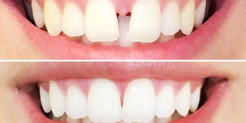 فاصله بین دندانی 