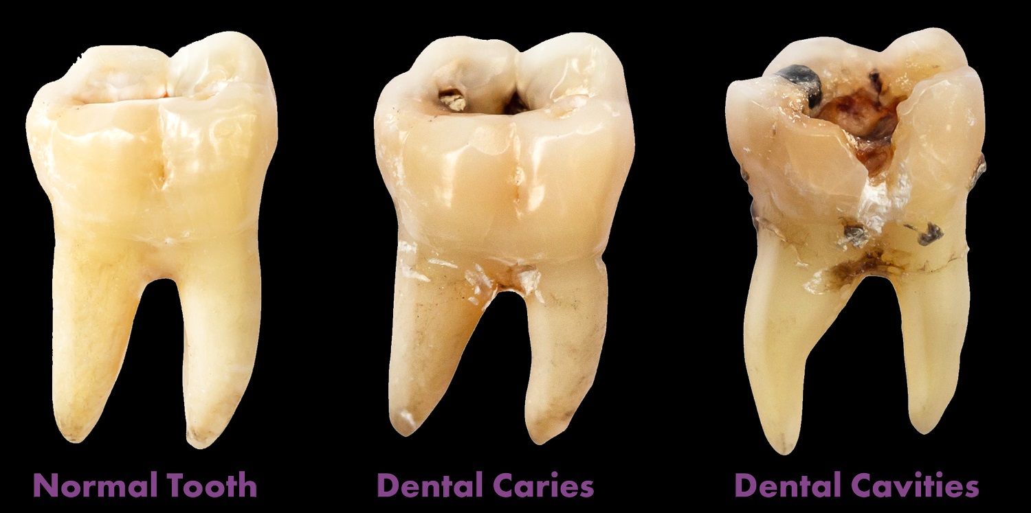 پوسیدگی دندان چپیست؟ 