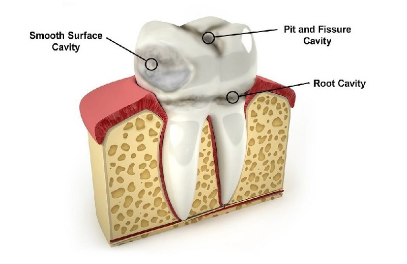 دسته‌بندی پوسیدگی دندان 