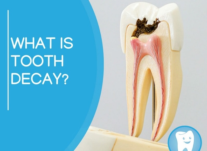 علت پوسیدگی دندان چیست؟ روش‌های درمان و ترمیم انواع پوسیدگی