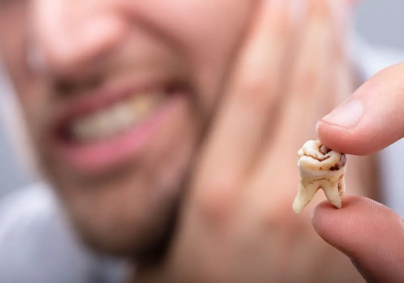 علائم پوسیدگی دندان 