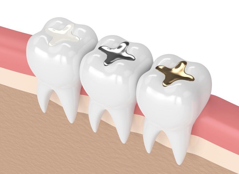 راه‌های درمان پوسیدگی دندان 