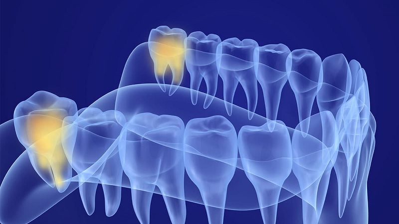 انواع دندان عقل 