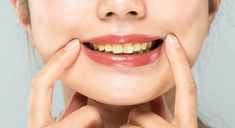 علت زرد شدن دندان چیست؟ چگونه رفع می‌شود
