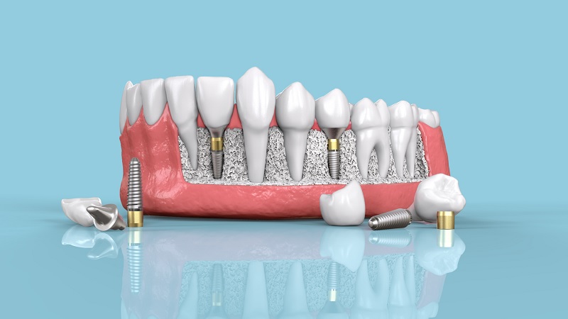 بهترین روش مراقبت بعد از ایمپلنت دندان