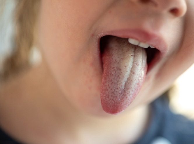 برفک دهان چیست و روش درمان آن چگونه است؟
