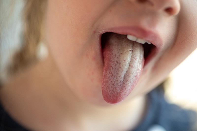 برفک دهان چیست و روش درمان آن چگونه است؟