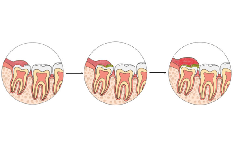 علائم Pericronite