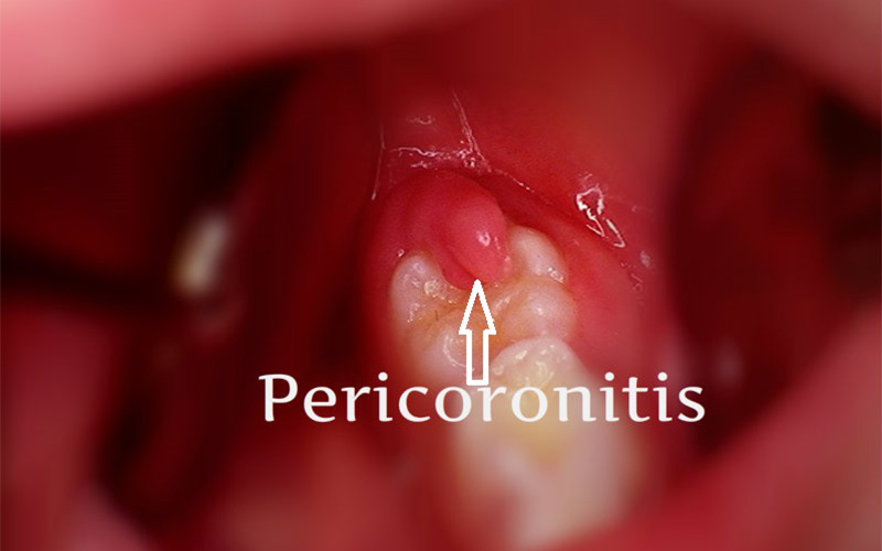 عدوى ضرس العقل