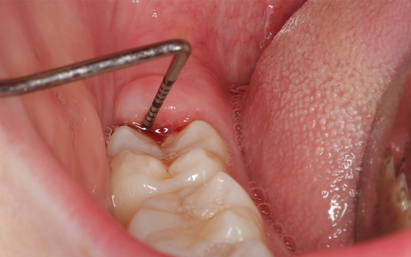 پریکرونیت درمان