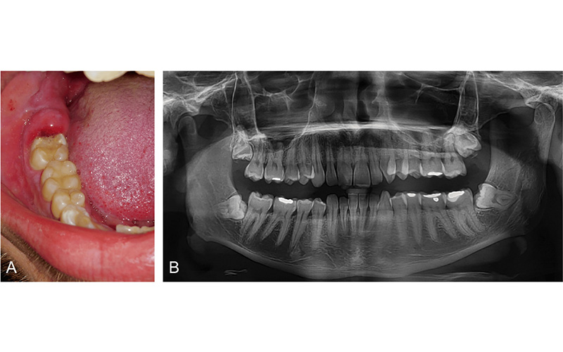 تشخیص عفونت عقل