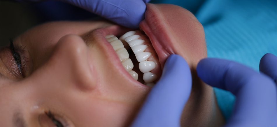 مراقبت‌های بعد از کامپوزیت دندان