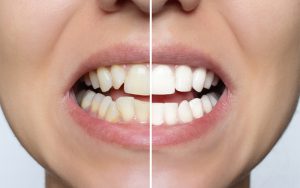 before and after tooth composite