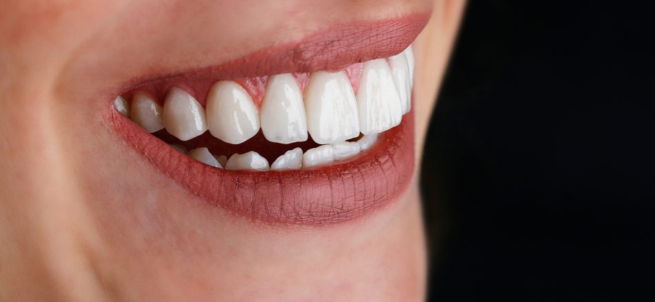 تراش دندان برای لمینت دندان