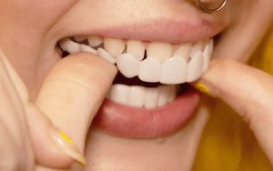 How to use the movable dental laminate