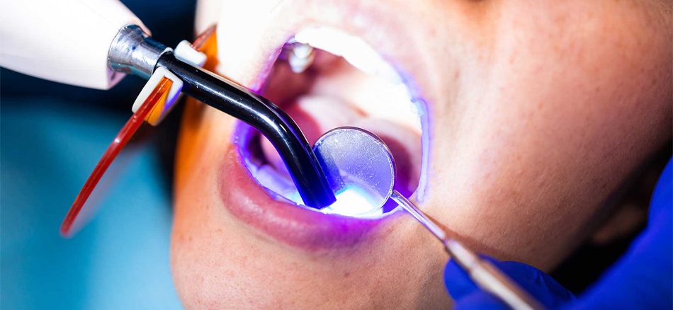 عوارض کامپوزیت دندان