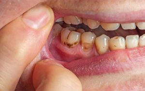 tooth الاضمحلال
